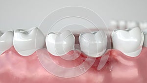 Caries in three stages - Stage 1 Gingivitis - 3D Rendering