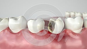 Caries in three stages - Stage 2 strong caries attack - 3D Rendering