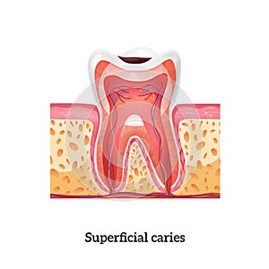 Caries Tooth Anatomy