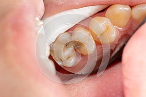 Caries and tooth disease. Filling with a dental composite photopolymer material using Rubber Dam. The concept of dental treatment photo