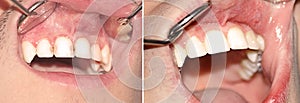 Caries before and after treatment