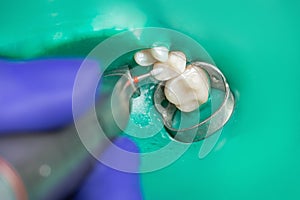 Caries treatment in the dental office, close-up