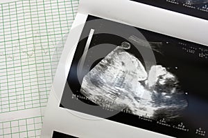 Cariograph and sonogram photo