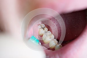 Carious lesions on chewing teeth, dental caries, aesthetic defect