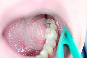 Carious lesions on chewing teeth, dental caries, aesthetic defect