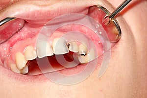 Carious teeth of the upper jaw