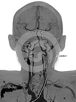 Carotid artery disease