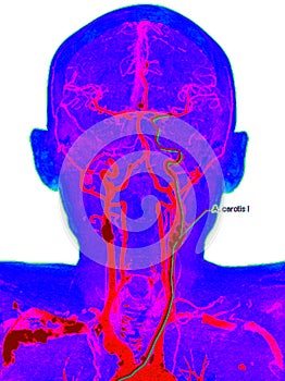 Carotid artery disease