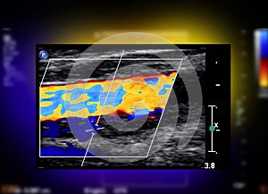 A carotid artery Doppler ultrasound is a diagnostic test used to check the arteries in the neck for diagnosis  any blockage in the
