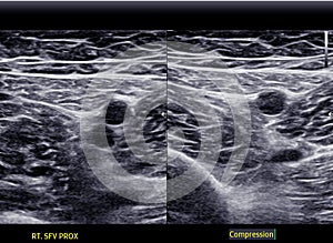 A carotid artery Doppler ultrasound is a diagnostic test used to check the arteries in the neck for diagnosis  any blockage in the