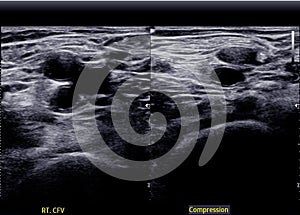 A carotid artery Doppler ultrasound is a diagnostic test used to check the arteries in the neck for diagnosis  any blockage in the