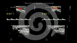 A carotid artery Doppler ultrasound is a diagnostic test used to check the arteries in the neck for diagnosis  any blockage in the