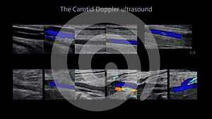 A carotid artery Doppler ultrasound is a diagnostic test used to check the arteries in the neck for diagnosis  any blockage in the