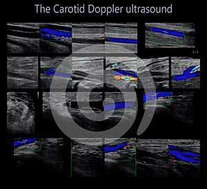 A carotid artery Doppler ultrasound is a diagnostic test used to check the arteries in the neck for diagnosis  any blockage in the