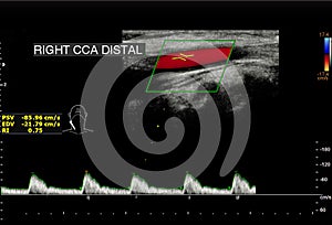 A carotid artery Doppler ultrasound is a diagnostic test used to check the arteries in the neck for diagnosis  any blockage in the