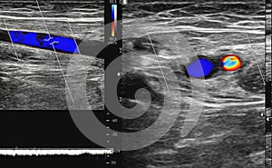 A carotid artery Doppler ultrasound is a diagnostic test used to check the arteries in the neck for diagnosis  any blockage in the