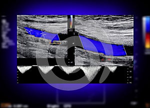 A carotid artery Doppler ultrasound is a diagnostic test used to check the arteries in the neck for diagnosis  any blockage in the