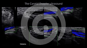 A carotid artery Doppler ultrasound is a diagnostic test used to check the arteries in the neck for diagnosis  any blockage in the