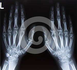 Carpal bones Human X Ray