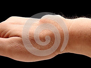 Carpal ganglion cyst photo