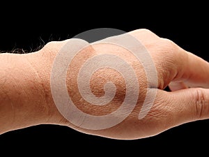 Carpal ganglion cyst photo