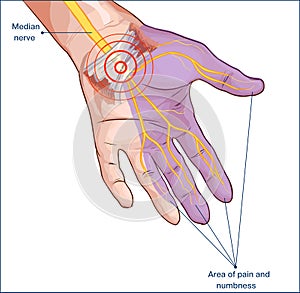 Carpal tunnel