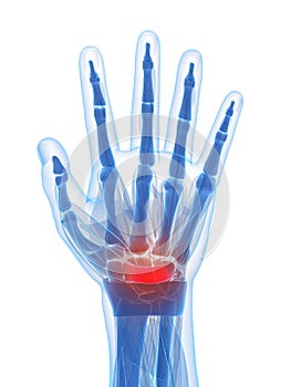 The carpal tunnel syndrome