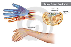 Carpal tunnel syndrome. Compressed median nerve. Anatomy of the carpal tunnel, showing the median nerve.
