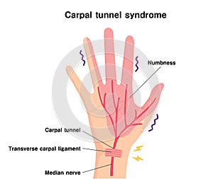 Carpal tunnel syndrome illustration