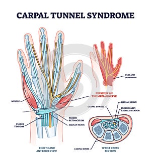 Carpal tunnel syndrome with median nerve pressure disease outline diagram