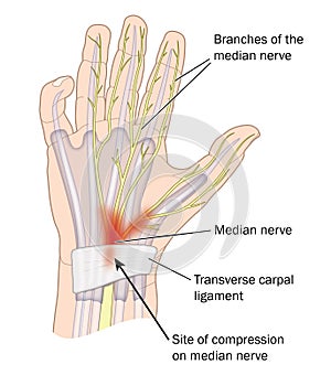 Carpal tunnel syndrome photo