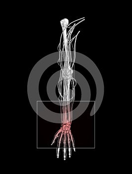 Carpal Tunnel Wrist Pain