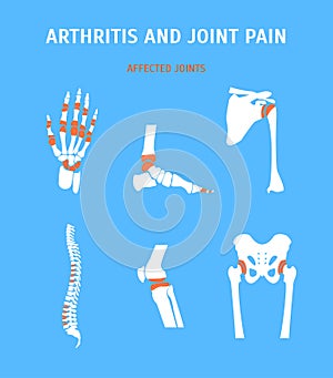 Cartoon Arthritis and Joint Pain Set. Vector