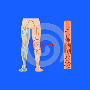 Cartoon Deep Vein Thrombosis Card Poster. Vector