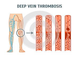 Cartoon Deep Vein Thrombosis Infographics Card Poster. Vector