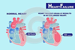 Heart failure concept photo