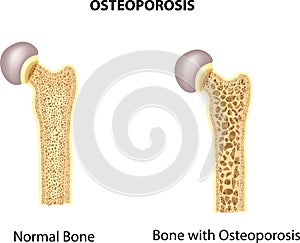 Cartoon illustration of bone of hip. normal bone and bone with osteoporosis