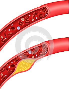 Cartoon illustration of cholesterol blocking artery