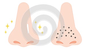 Cartoon illustration of clogged pores and clean pores on nose