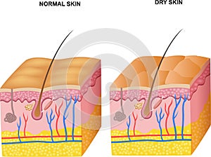 Cartoon illustration of The layers normal skin and dry skin