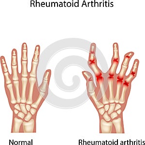 Cartoon Illustration of Rheumatoid Arthi