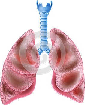 Cartoon Illustration of Smokers Lungs on white background photo