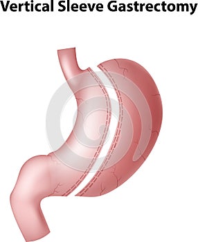 Cartoon illustration of vertical sleeve gastrectomy