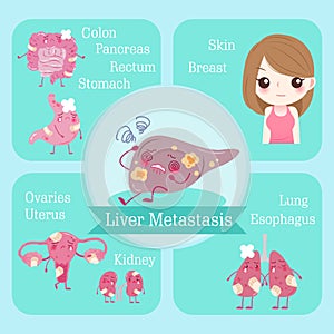 Cartoon liver metastasis