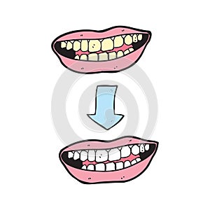 Cartoon before and after teeth bleaching or whitening treatment