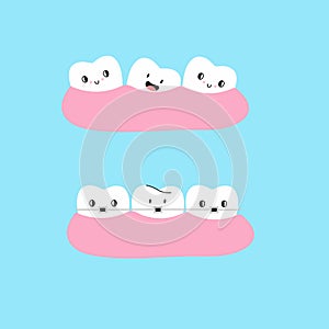 Cartoon Teeth in gum. Straight and crooked teeth. Braces before and after orthodontic treatment. Dental clinic comic mascot,