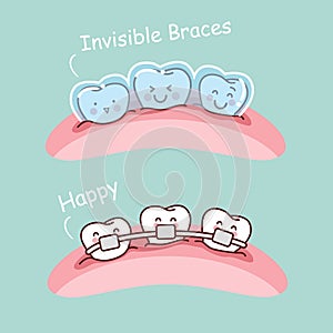 Cartoon tooth with invisible braces