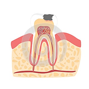 Cartoon Tooth with Stage of Dental Caries Formation. Vector photo