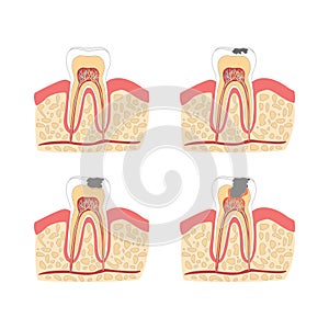 Cartoon Tooth with Stages of Dental Caries Formation Set. Vector photo