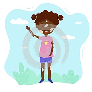 Cartoon vector illustration of happy girl with vitiligo syndrome. Body positive